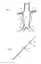 Fig. 07 - Intraluminal polymeric devices for the treatment of aneurysms