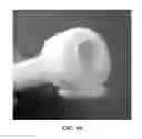 Fig. 16 - Intraluminal polymeric devices for the treatment of aneurysms