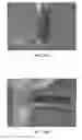 Fig. 19 - Intraluminal polymeric devices for the treatment of aneurysms