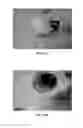 Fig. 23 - Intraluminal polymeric devices for the treatment of aneurysms
