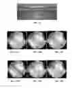 Fig. 24 - Intraluminal polymeric devices for the treatment of aneurysms
