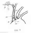 Fig. 08 - Dual endovascular filter and methods of use