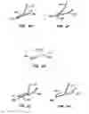 Fig. 16 - Distal protection devices and methods of providing distal protection