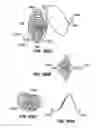 Fig. 50 - Distal protection devices and methods of providing distal protection