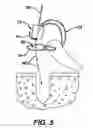Fig. 05 - Adjustable anchor systems and methods