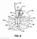 Fig. 06 - Adjustable anchor systems and methods