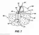 Fig. 07 - Adjustable anchor systems and methods