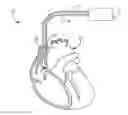 Fig. 01 - Bundle of his stimulation system