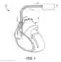 Fig. 02 - Bundle of his stimulation system