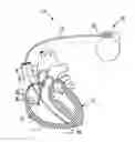 Fig. 01 - RF rejecting lead