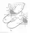 Fig. 01 - Defibrillator with pre-connected electrode pads with reduced susceptibility to false asystole indications