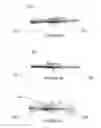 Fig. 04 - Method of securing a prosthesis