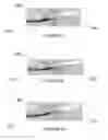 Fig. 05 - Method of securing a prosthesis