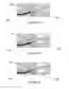 Fig. 06 - Method of securing a prosthesis