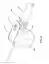 Fig. 22 - Methods and apparatuses for deploying minimally-invasive heart valves
