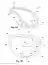 Fig. 02 - Apparatus and method for treating a regurgitant heart valve