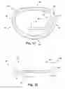 Fig. 03 - Apparatus and method for treating a regurgitant heart valve