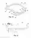 Fig. 06 - Apparatus and method for treating a regurgitant heart valve