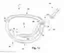 Fig. 07 - Apparatus and method for treating a regurgitant heart valve