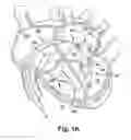Fig. 08 - Apparatus and method for treating a regurgitant heart valve