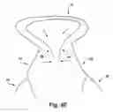 Fig. 14 - Apparatus and method for treating a regurgitant heart valve