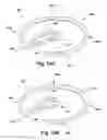 Fig. 33 - Apparatus and method for treating a regurgitant heart valve