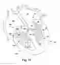 Fig. 34 - Apparatus and method for treating a regurgitant heart valve