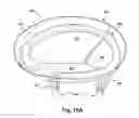 Fig. 35 - Apparatus and method for treating a regurgitant heart valve