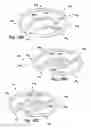 Fig. 40 - Apparatus and method for treating a regurgitant heart valve