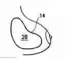 Fig. 01 - Tissue marking implant