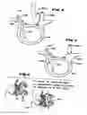 Fig. 04 - Facet Arthroplasty Devices and Methods