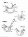 Fig. 05 - Facet Arthroplasty Devices and Methods