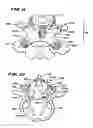 Fig. 06 - Facet Arthroplasty Devices and Methods