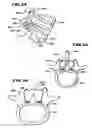 Fig. 07 - Facet Arthroplasty Devices and Methods