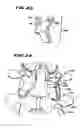 Fig. 10 - Facet Arthroplasty Devices and Methods