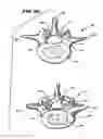 Fig. 13 - Facet Arthroplasty Devices and Methods