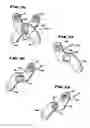 Fig. 17 - Facet Arthroplasty Devices and Methods