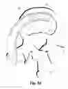 Fig. 07 - Spinal implant system and method