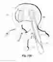 Fig. 14 - Spinal implant system and method
