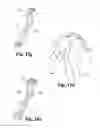 Fig. 23 - Spinal implant system and method