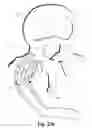 Fig. 50 - Spinal implant system and method