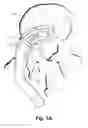 Fig. 52 - Spinal implant system and method