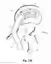 Fig. 53 - Spinal implant system and method