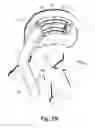 Fig. 55 - Spinal implant system and method