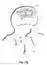 Fig. 56 - Spinal implant system and method