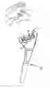 Fig. 01 - Method of shoulder arthroplasty with adjustable angle of inclination