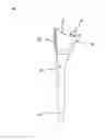Fig. 07 - Method of shoulder arthroplasty with adjustable angle of inclination