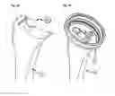 Fig. 15 - Method of shoulder arthroplasty with adjustable angle of inclination
