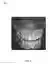 Fig. 03 - SYSTEMS FOR DENTURE PREPARATION