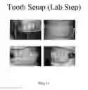 Fig. 12 - SYSTEMS FOR DENTURE PREPARATION